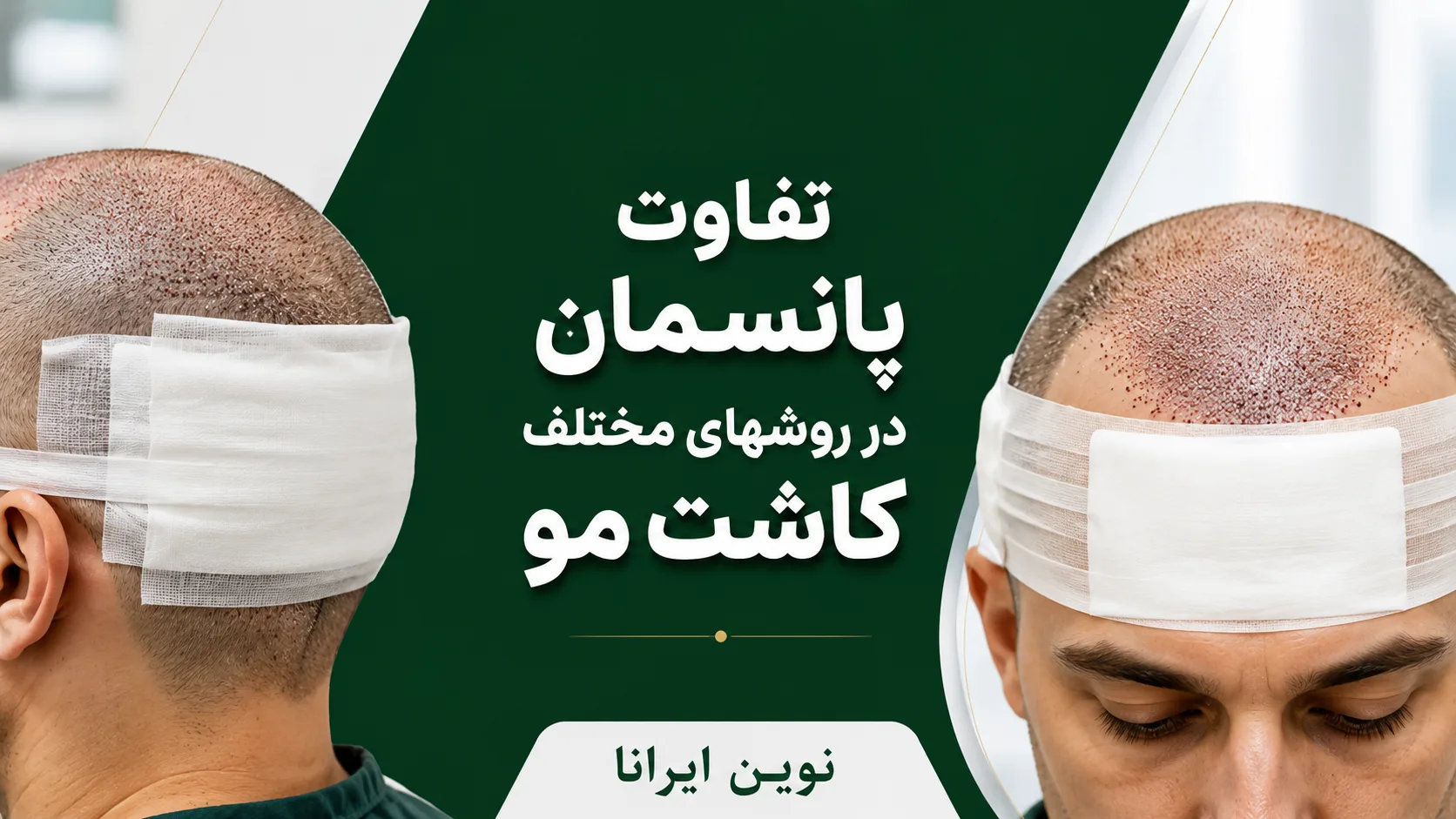 تفاوت پانسمان در روشهای مختلف کاشت مو